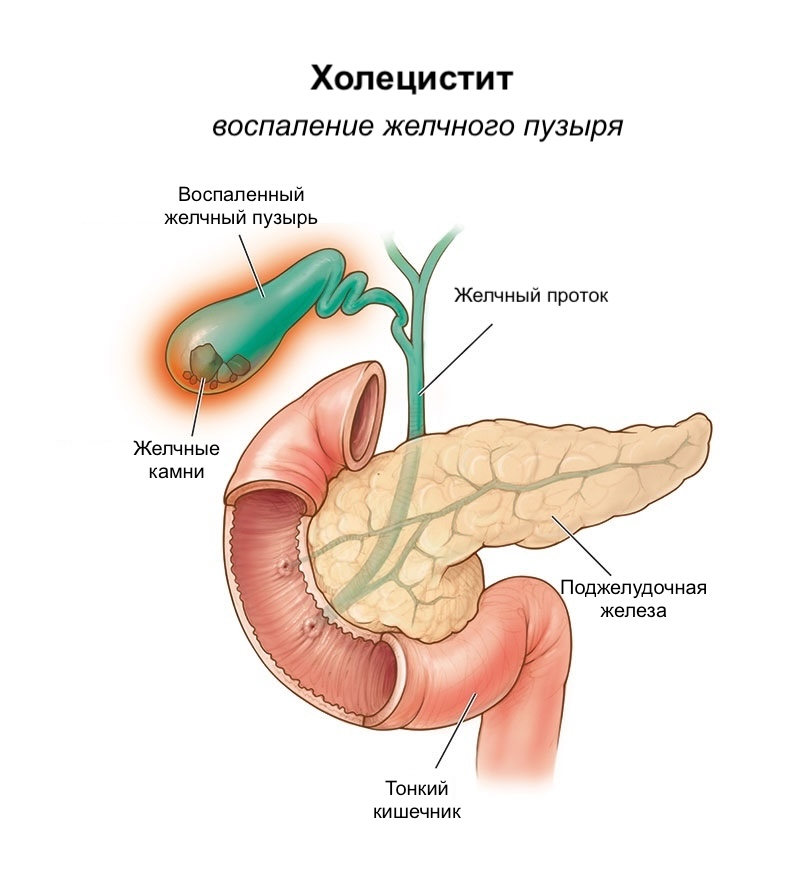 Холецистит