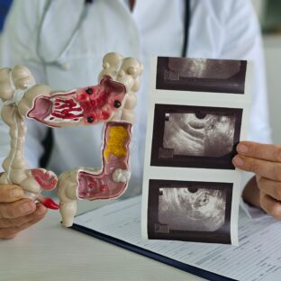 Лечение и удаление свища прямой кишки в Ставрополе