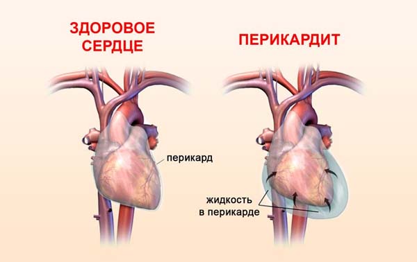 Здоровое сердце и перикардит