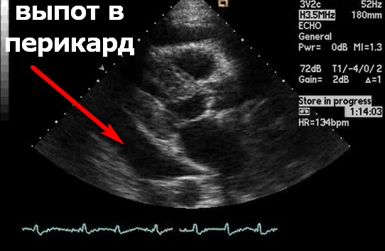 УЗИ сердца перикардит