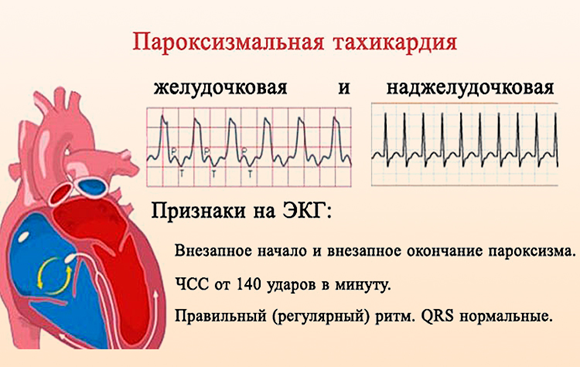 Пароксизмальная тахикардия