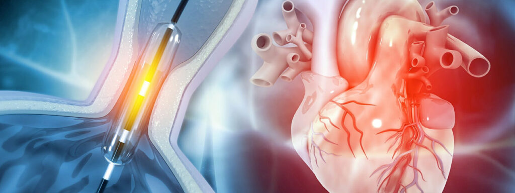 Коронография