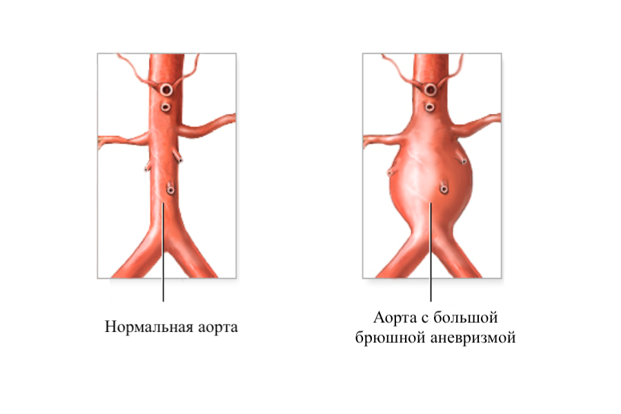 Аневризма аорты