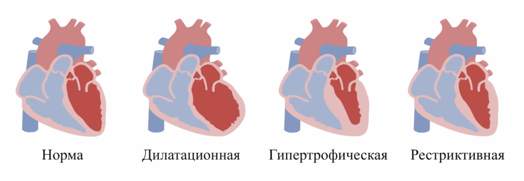 Типы кардиомиопатий