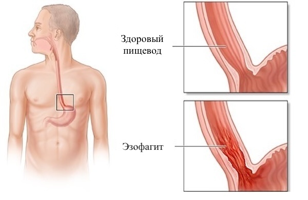 Эзофагит