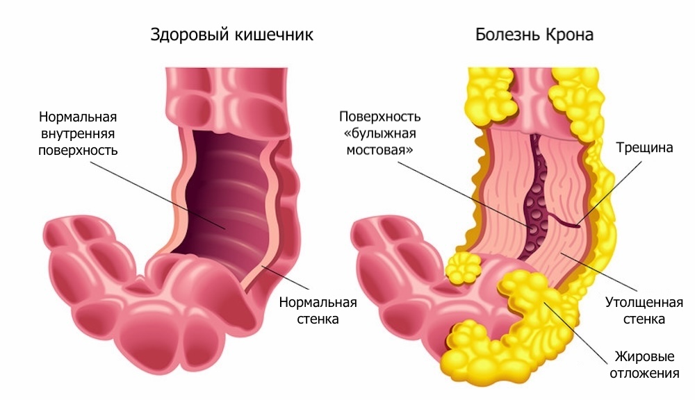 Болезнь Крона