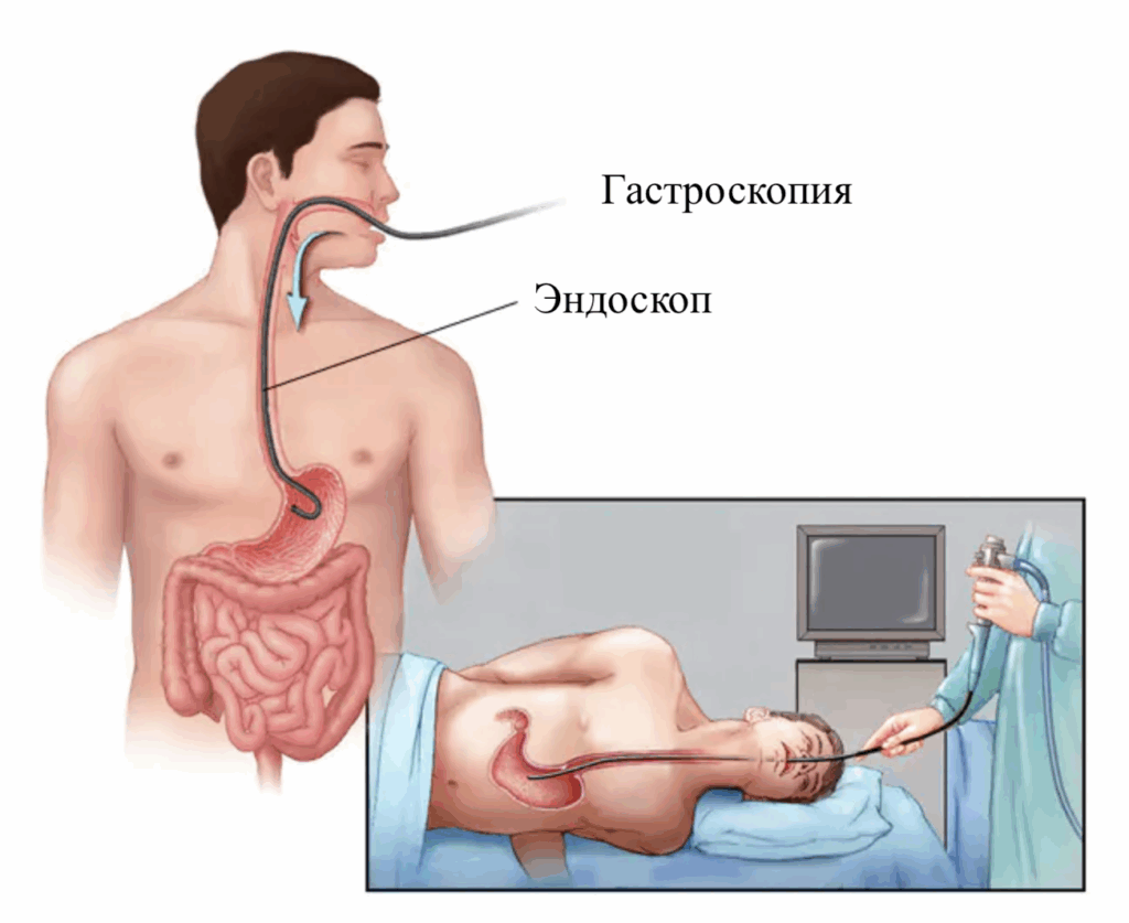 Диагностика язвы