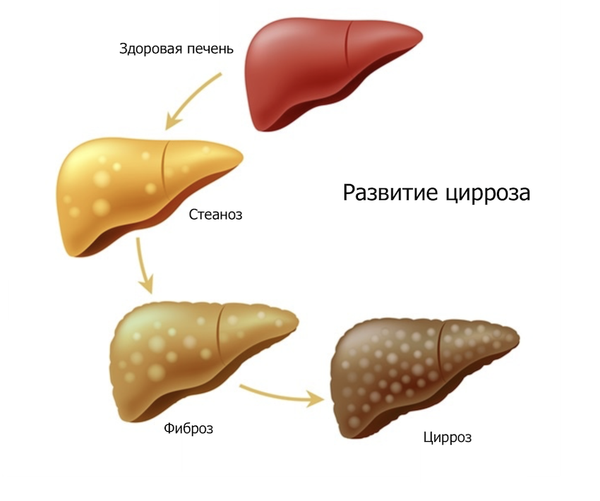 Стадии цирроза