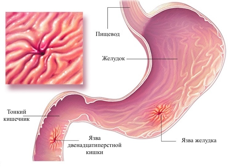 Язвенная болезнь