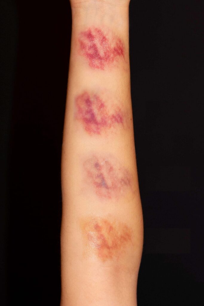 Стадии гематомы