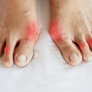 Подагра: первые симптомы, причины, лечение и когда нужно срочно обращаться к врачу