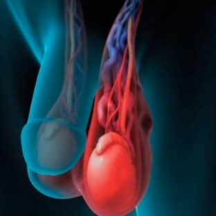 Почему варикоцеле нельзя игнорировать даже без боли